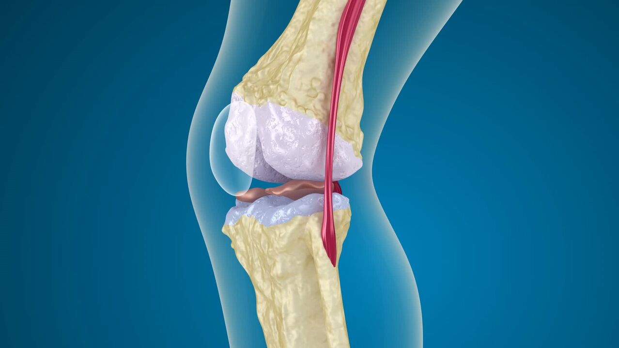 Destrución da articulación do xeonllo na artrose