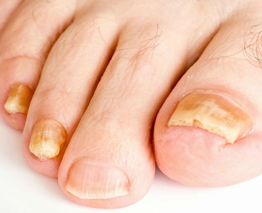 Cogomelo nas uñas