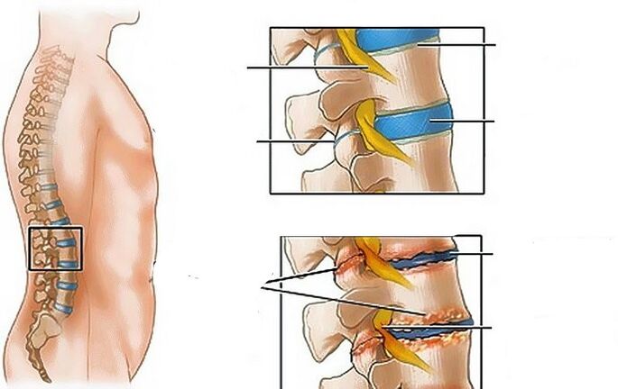 Osteocondrose da rexión lumbar