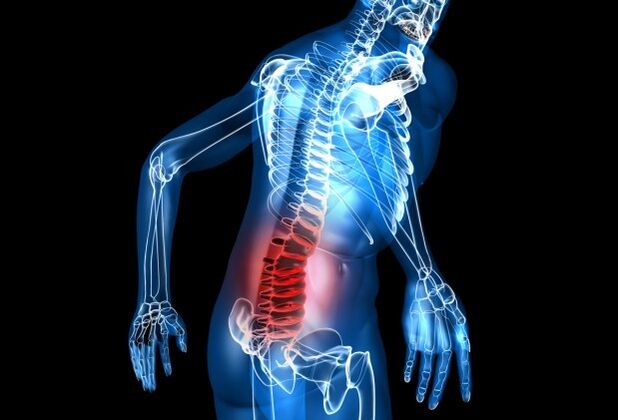 Síntomas da osteocondrose