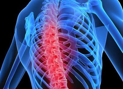 Osteocondrose da columna torácica