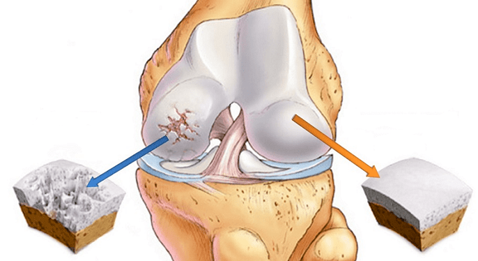 cartilaxe saudable afectada pola artrose